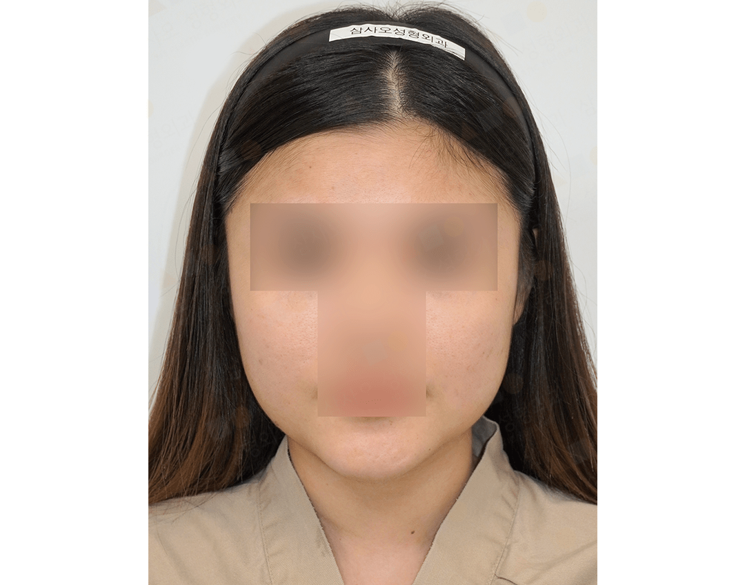 Asian woman before 345 plastic surgery procedure for natural look