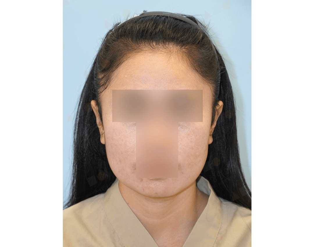 Asian woman before 345 plastic surgery procedure for natural looking results.