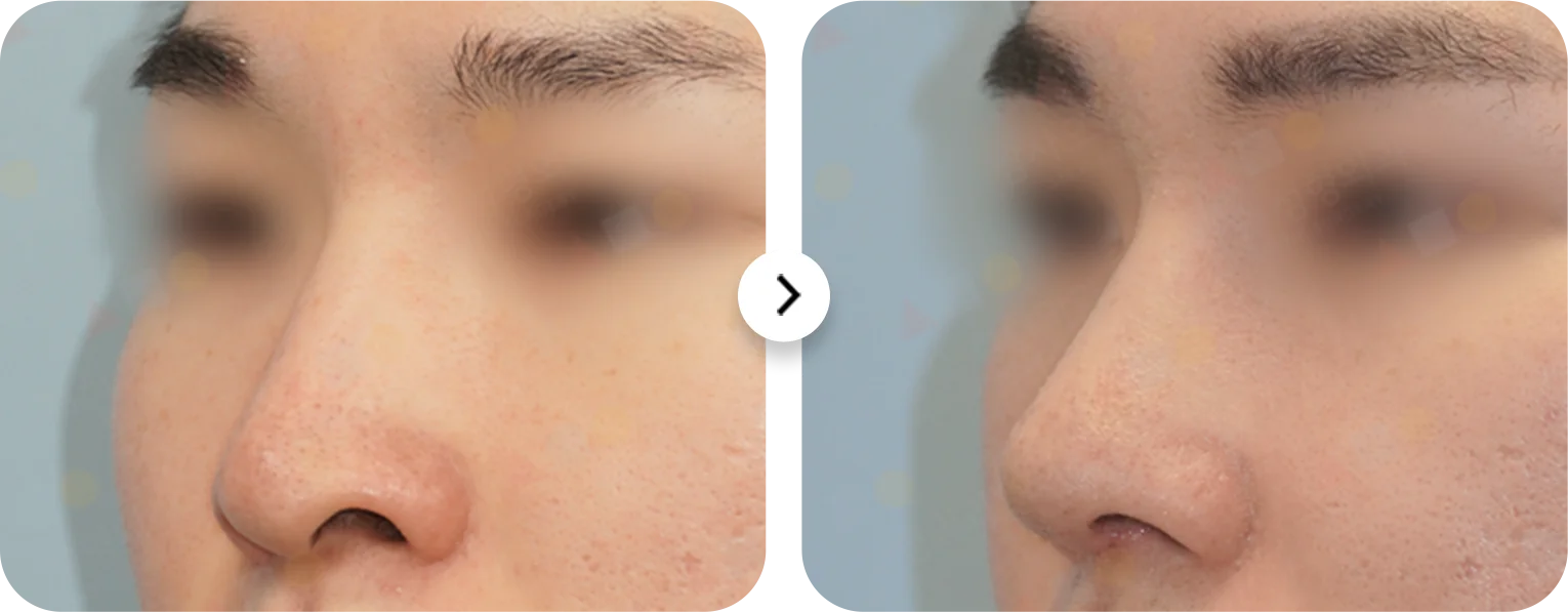 Rhinoplasty before and after. 345 Plastic Surgery where natural nose job results.