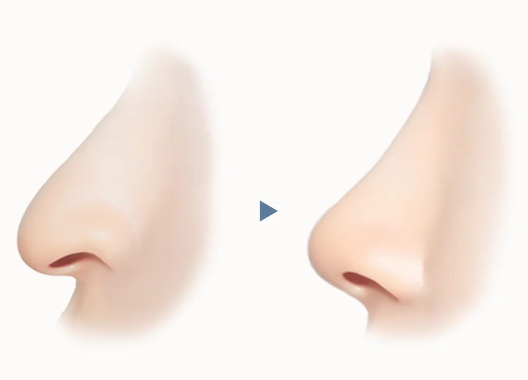 Rhinoplasty before and after 345 plastic surgery where natural nose job cosmetic surgery
