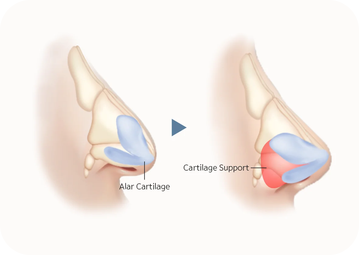 Plastic surgery illustration showing alar cartilage before and after cartilage support for natural 345 nose reshaping.
