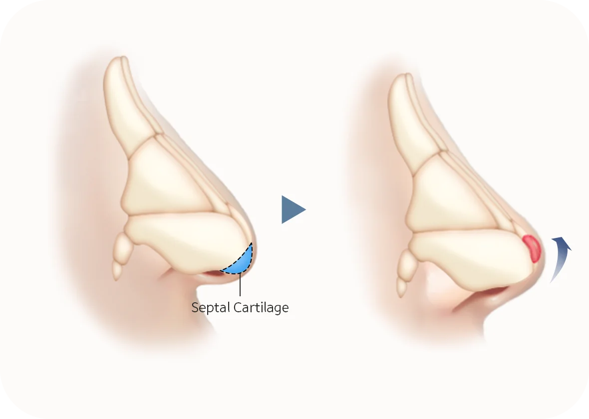 Septal cartilage graft for natural 345 plastic surgery. Nose job illustration.