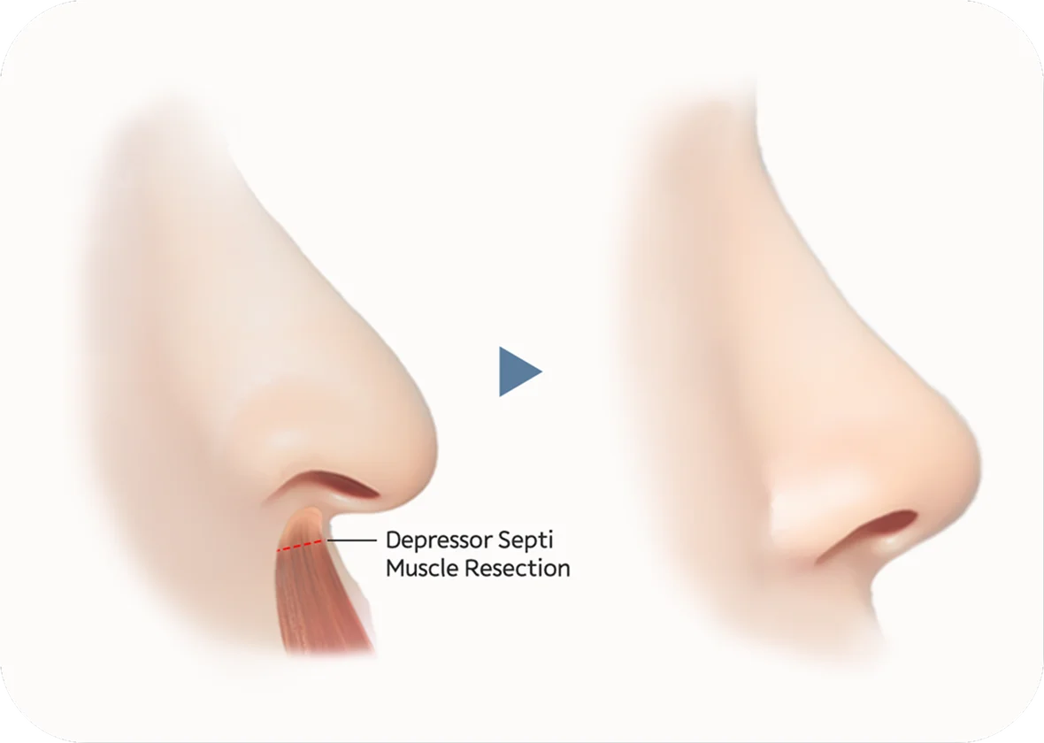 Plastic surgery nose job before and after. Depressor septi muscle resection for natural 345 plastic surgery.