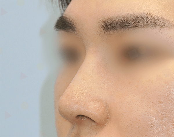 Profile view of a nose before 345 plastic surgery where natural.