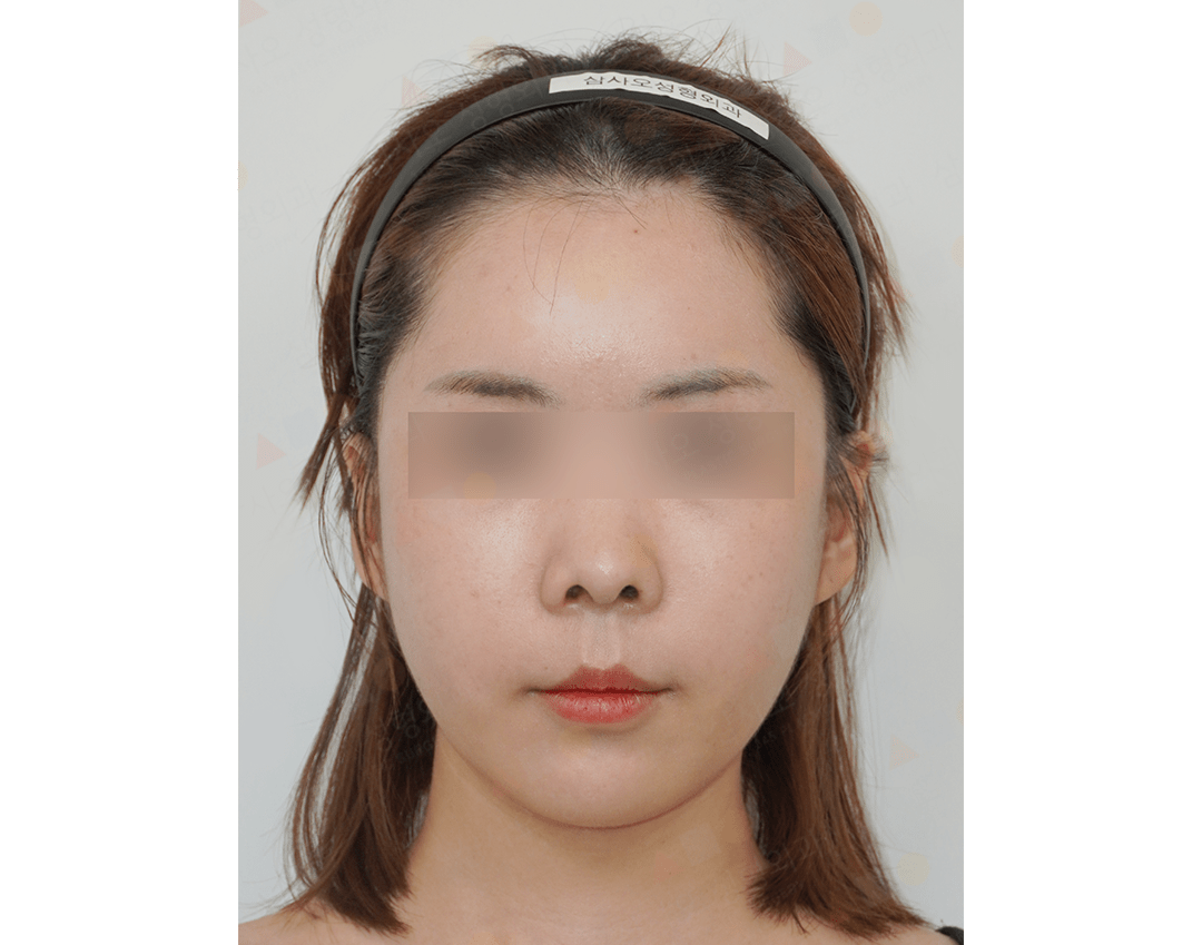 Asian woman before 345 Plastic Surgery where natural face view.