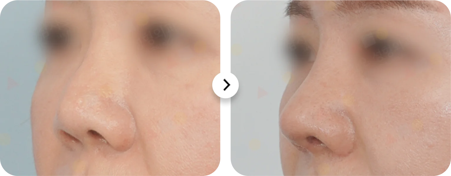 Rhinoplasty before and after. Nose plastic surgery for natural results. 345 Plastic Surgery.