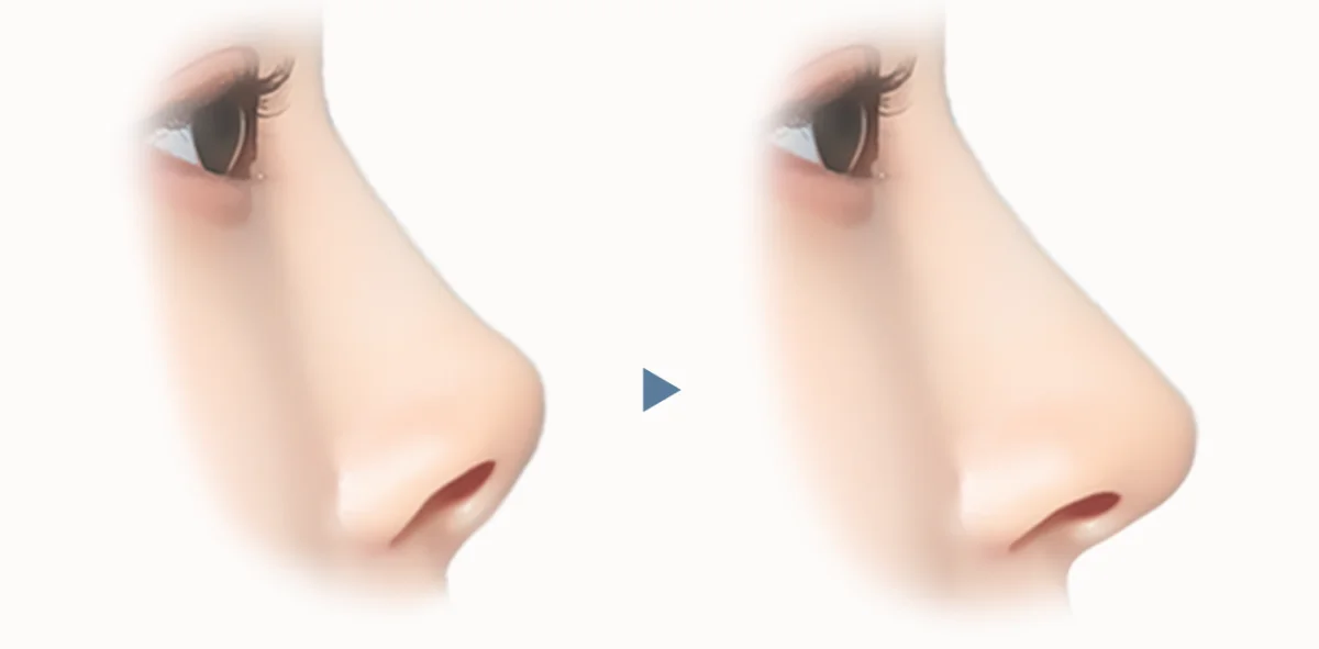 Rhinoplasty before and after plastic surgery. 345 Plastic Surgery where natural.