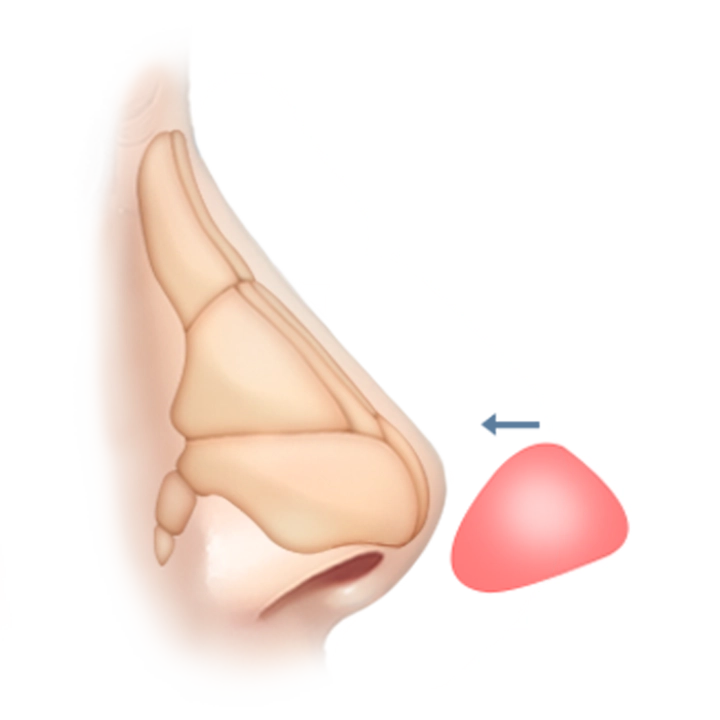 Nose anatomy for plastic surgery where natural 345. Rhinoplasty illustration.