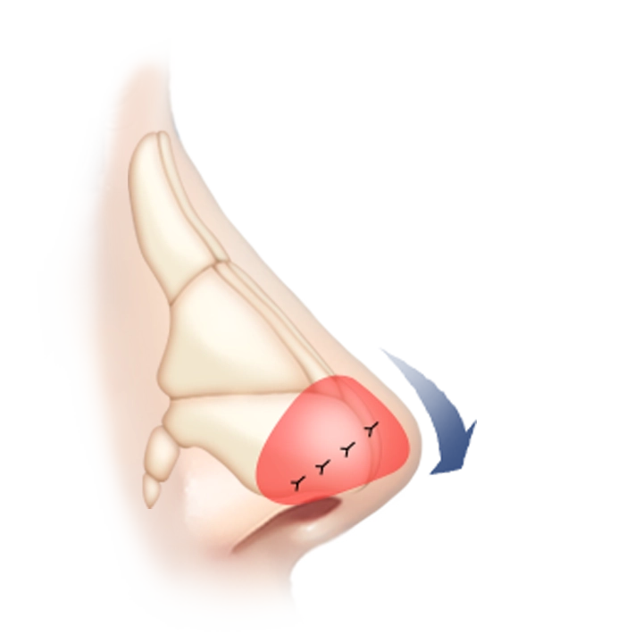 Nose job diagram for 345 plastic surgery where natural rhinoplasty.