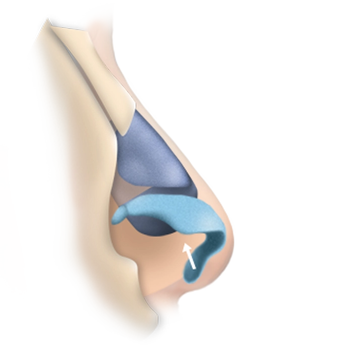 Illustration of nasal anatomy for 345 plastic surgery where natural results are achieved.