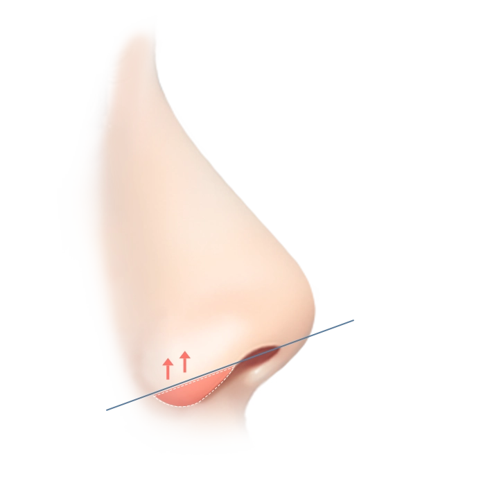 Nose plastic surgery diagram shows natural 345 plastic surgery results. Rhinoplasty where natural.