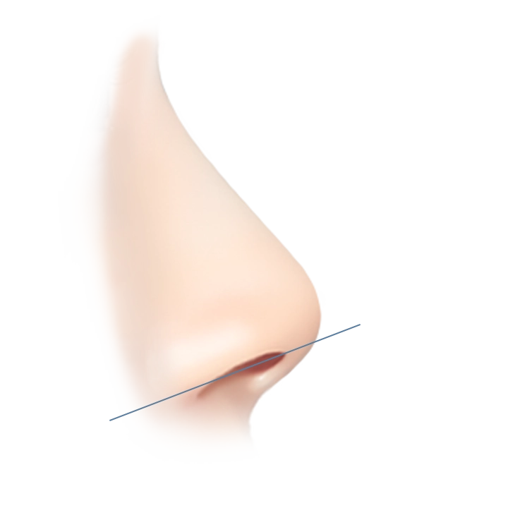 Illustration of nose plastic surgery for natural 345 results.