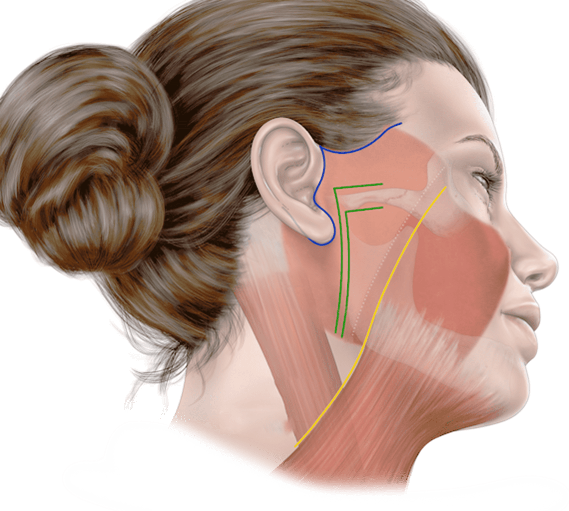 Facial plastic surgery diagram showing face and neck muscles for natural results. 345 Plastic Surgery.